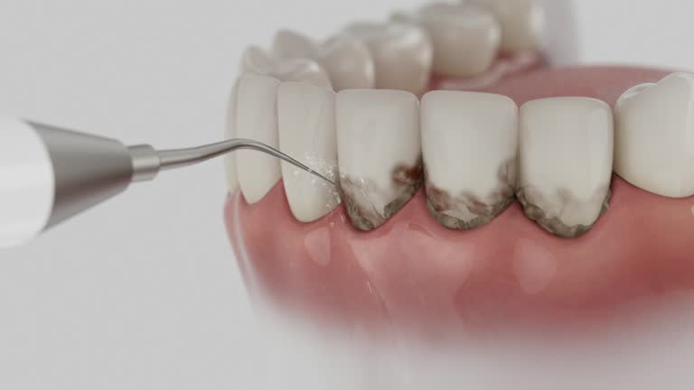 Trusted Wisdom Tooth Removal service in Shiremanstown, PA - Dentist Open Now